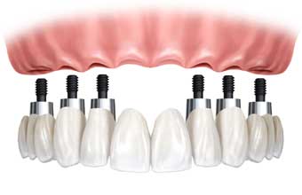 Dental Prótese - Foto 1